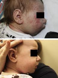 Image result for Micrognathia