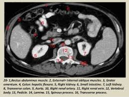 Almost every movement in the body is the outcome of muscle contraction. Presentation1 Pptx Ct Normal Anatomy Of The Abdomen And Pelvis