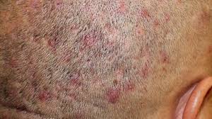 Image result for dry scabs on the head in children