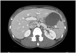 Jcm Free Full Text Degree Of Left Renal Vein Compression Predicts Nutcracker Syndrome