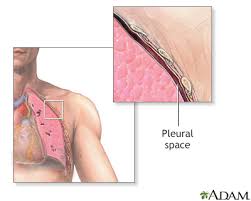 Chest Tube Insertion Information Mount Sinai New York