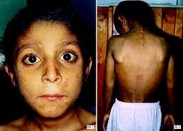 Early-Onset Jaundice with Severe Pruritus