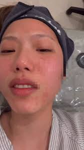 奉勸自己不要再花錢討皮痛🙃🙃🙃效果再好都不允許，我甚至是很能熱痛的人ㄟ⋯ #麗珠蘭 #韓國醫美