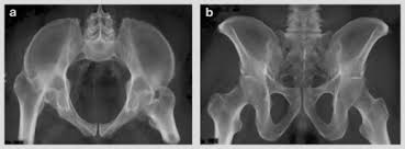 Systematically examine all bony structures of the pelvis and femurs for symmetry, cortical breaks and joint spaces (sacroiliac, hip and. Radiography Anatomy And Imaging In Pelvic Fractures Sciencedirect