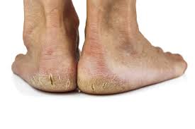We did not find results for: Treating Foot Pain Associated With Diabetes Pain Doctor