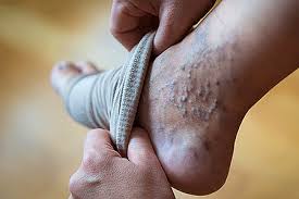Image result for Stasis Dermatitis
