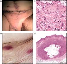 Image result for Vulvar Cancer