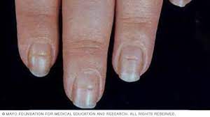The indentations can appear when growth at the area under the cuticle is interrupted by injury or severe illness. Slide Show 7 Fingernail Problems Not To Ignore Mayo Clinic