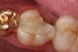 Image result for Tooth Fracture