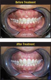 When filled with botox, the lip will not rise up as high and will cover either most or all of the gums. How To Fix A Gummy Smile Blog
