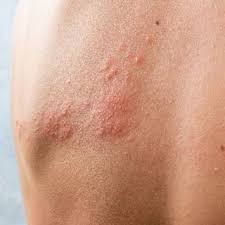 Image result for herpes zoster