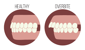 This treatment lasts for 18 months. Overbite Or Buck Teeth The Steps To The Smile You Ve Always Wanted Sherman Balhoff