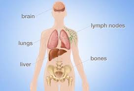 As the breast cancer cells colonize tissues in the shoulder, they attack neighboring healthy cells and cause tissue damage that can lead to pain. Where Breast Cancer Spreads Lymph Nodes Bones Liver Lungs Brain