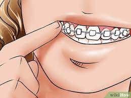 The wax should still stick out. How To Apply Dental Wax On Braces 12 Steps With Pictures