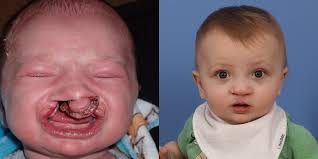 Image result for Cleft Lip