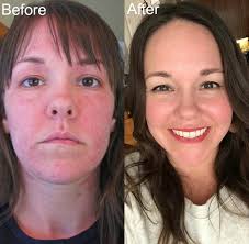 ■■ how long will i have to be in the hospital? How I Reversed Hashimoto S A Thyroid Autoimmune Disease With Diet