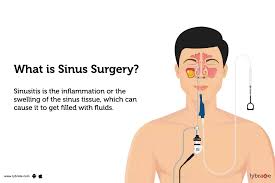 Image result for Sinus Surgery