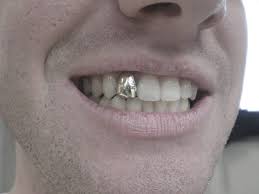Custom arctic cut design grillz white gold teeth 8k, 10k, 14k or white silver. How Much Does Permanent Gold Teeth Cost
