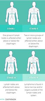 Non Hodgkin S Lymphoma Nhl Stages Chart Non Hodgkin S Lymphoma Lymphoma Non Hodgkins Lymphoma Symptoms