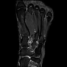 Bone contusions, osteonecrosis, marrow oedema syndromes, and stress > fractures) > synovial based disorders ( eg. Normal Foot Mri Radiology Case Radiopaedia Org