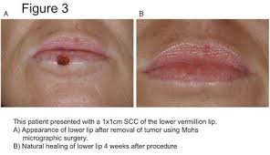 Image result for Lip Cancer