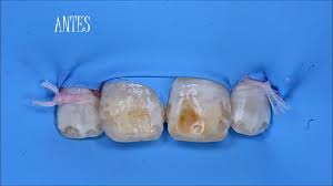 Casos De Fluorosis Por Antivet Youtube Antivet kit dental whitening and enamel cleaning kit new treatment to fluorosis. casos de fluorosis por antivet