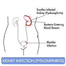 Pin By Megan Lucius On Learning Chemistry Remedies For Kidney Infection Kidney Infection Natural Cures