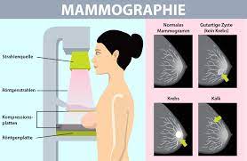 Mammographie Rontgen Der Brust Bruste Brustdrusen