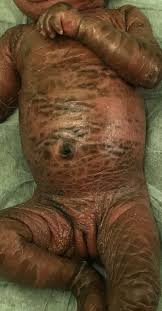 Image result for Ichthyosis