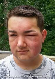 Swollen Poison Ivy Face Rash