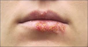 Ciri Ciri Penyakit Herpes Di Bibir By Bahaya Herpes Medium