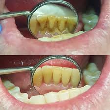Calculus Deposits Around Bottom Anterior Teeth Before And After A Professional Dental Scale And Polish Dental Fun Dental Health Dental Fun Facts