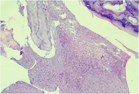 Image result for Necrotizing Otitis Externa