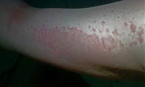 635 Msg Boosters Ribo Rash Ribonucleotides 627 631 Food Intolerance Network