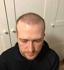 Wann wachsen die haare nach einer haartransplantation? Wachstum Nach Haartransplantation Nach 3 Monaten Erstes Ergebnis