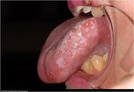 Image result for white cancer on tongue)