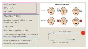 Image result for Oculovestibular Testing