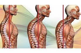 Famous physical therapists bob schrupp and brad heineck present how to get rid of neck hump using a sock. What Is The Hump At The Back Of Your Neck Physiocore Therapy Clinic Thornhill