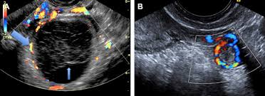 Image result for corpus luteum sonography)