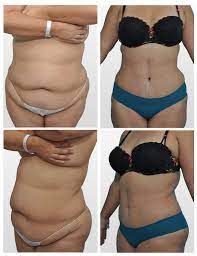 Our prices are among the most affortable in south florida. Tummy Tuck In Homestead Florida Dr Carlos Spera Plastic Surgery In Miami