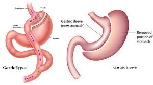 gastric sleeve weight loss surgery in iran