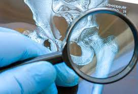 One of the most frequent symptoms associated with bone cancer is bone pain. What Does Bone Cancer In The Hip Feel Like