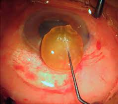 Many people choose to stay awake during surgery. Community Eye Health Journal Managing Cataract Surgery In Patients With Glaucoma
