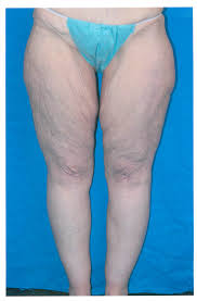 Thigh Lift Sugar Land Plastic Surgeon