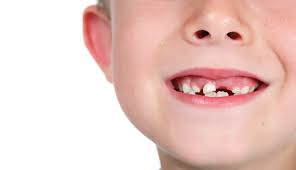What Should I Do If My Child Falls Knocks Out A Tooth All Pro Dental