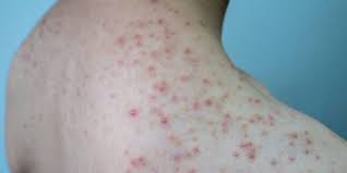 Image result for folliculitis symptoms