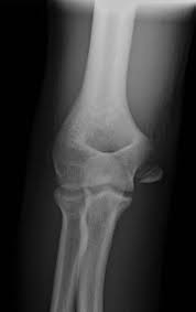 The medial epicondyle of the humerus is an epicondyle of the humerus bone of the upper arm in humans. Medial Epicondyle Fractures Elbow Dislocations And Transphyseal Separations Springerlink