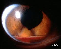 Image result for Hypopyon