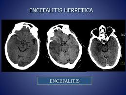 La gravedad puede variar con síntomas que incluyen las causas de la encefalitis incluyen virus como el virus del herpes simple y la rabia, así como. Encefalitis Herpetica Que Es Sintomas Tratamiento Y Mas