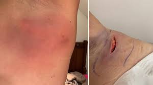 False Widow Spider Bite Leaves Barry Woman In Hospital Bbc News